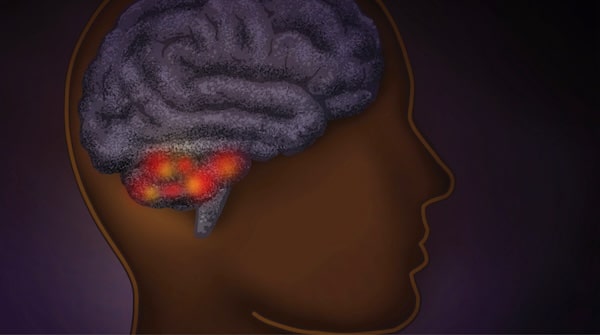 Illustration of a human head in profile with a visible brain, highlighting an area of inflammation or disease in the frontal lobe related to brain aging.